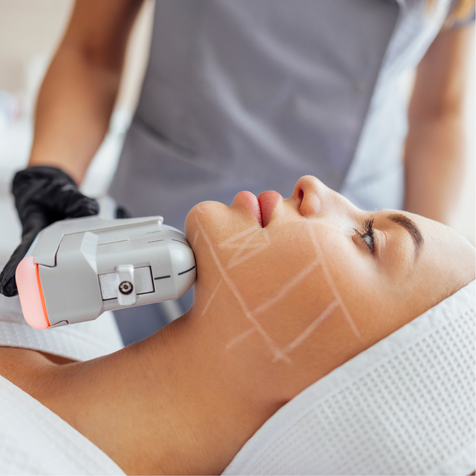 HIFU 12D Facial