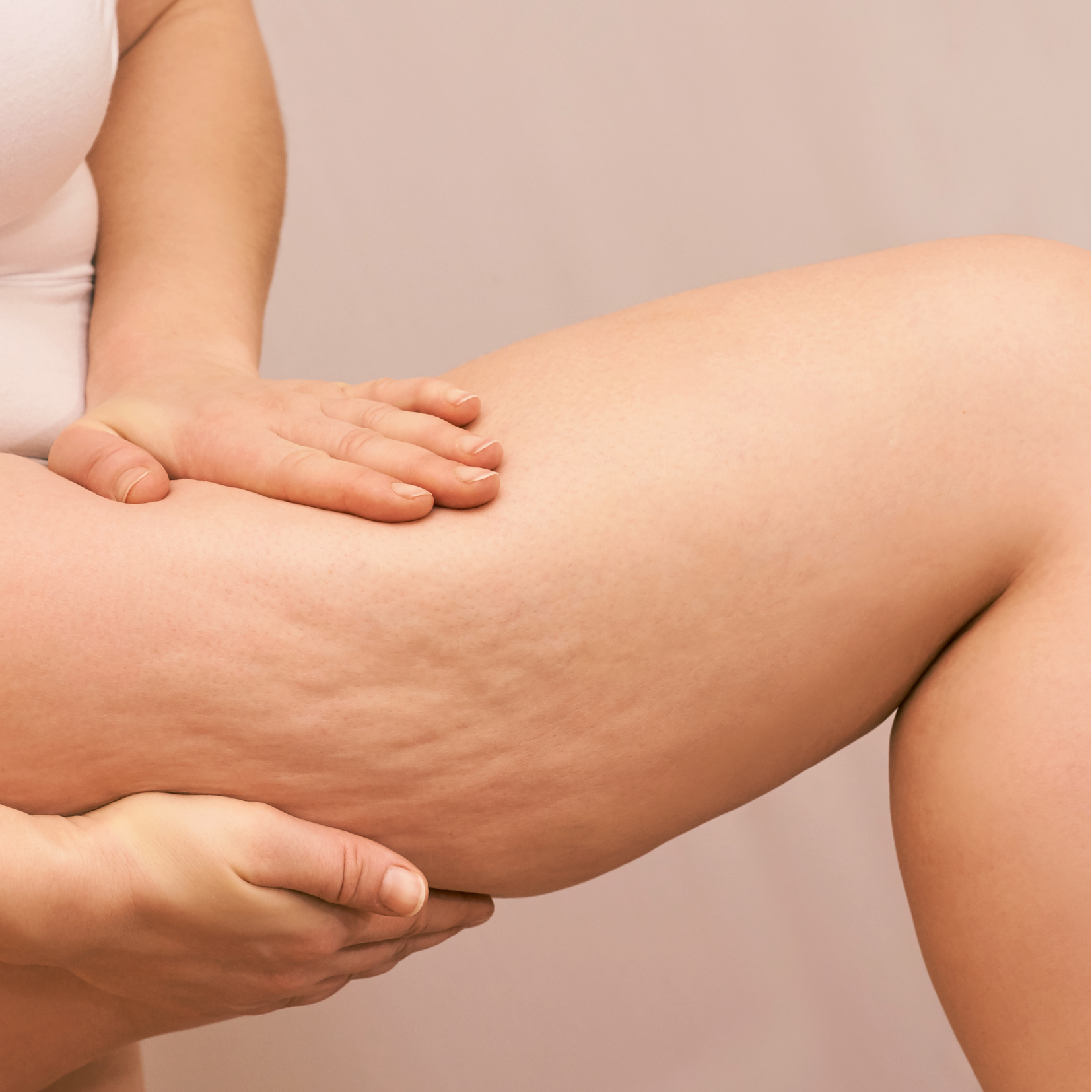 Tratamiento de PEFE (Celulitis)